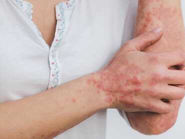 Tips to Help Psoriasis Naturally