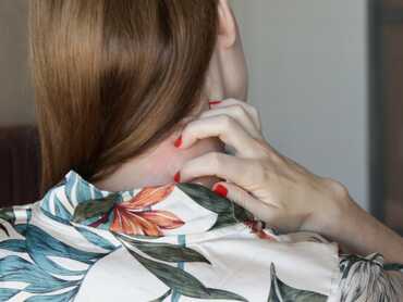 How To Ease The Pain and Discomfort of Shingles Naturally