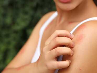 Incognito an Effective Natural Remedy for Insect Bites