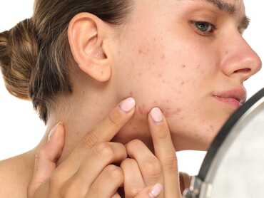 How Stress, Hormones & Lifestyle Factors Affect Acne