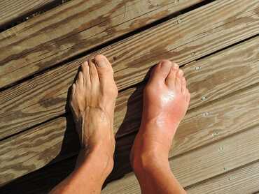 What is Gout?