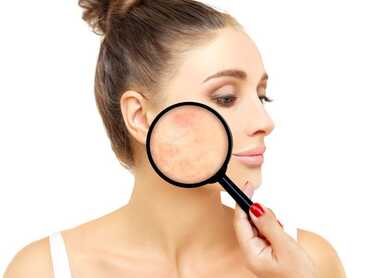What is Rosacea?